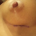 4 days PO scar..no bruising!