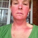 Day 3...hives beginning