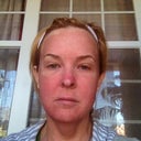 day 4...pain subsiding but still puffy
