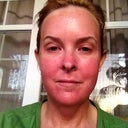 Still day 4 but I tried Vitamin E ointment and that has really helped with getting all the dead skin off and speeding up healing.