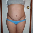 4 months post op Front
Look at the right side and left, they dont look right .. the right side pokes out more.. Had revision done