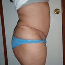 4 months post right
DUnno if u can tell from this angle how the pocket of fat pokes out
had revision done
