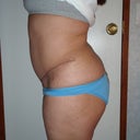 4 months post op left
will most likely have revision on this side done as well.