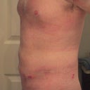 24hrs after procedure.