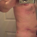 24hrs after procedure. (That's my hand "down there"..not my manhood!)