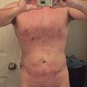 24hrs after procedure.