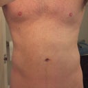 Morning of procedure.