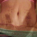 close up of scar 3 weeks. don't you just love the wave! A good indicator of swell level is how raised my stretch marks are...the more swollen I get the higher they go.