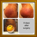 8 days after surgery