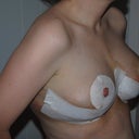 One day post-op, showing bruising from lipo under the arms. Oof, that hurt.