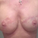 After having alloderm put in the nipples and having areolas tattooed by Vinnie Meyers.