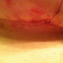 T-junction opening...some of the redness is from the steri strips they pulled off.