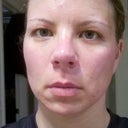This picture was taken the night before the EMatrix treatment. I admit I was tired. My face looks very dull.