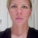 I took this picture the evening after the treatment, exactly 8 hours later.
