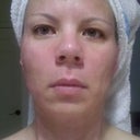 My face is less red the following morning and no pain, just a little dryness. I also look a little swollen.