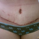 1 week post op