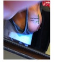 notice implant sits in a mound above flat area that is above the nipple