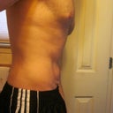 12 months, side, slight angle to show loose skin on lower abdomen.