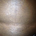 C-section scar..not bad. Hoping my scar would be this low