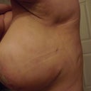 see the knots & dent in my back /underarm areas :/