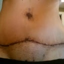 PO day 7...still swollen