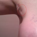 Dent On Outside of Armpit/Chest