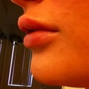 1 hr after, swollen