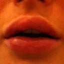 1 hr after, swollen
