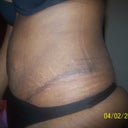 LFT side of scar