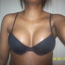 Breasts at 3 1/2 weeks post op