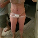 9 Days Post-Op