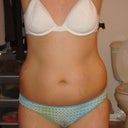 stretch marks are from being on Prednisone for 12 years.