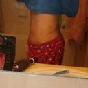 1 day post op