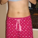 2 days post-op
