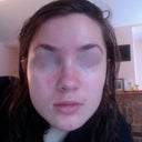 6 months of religious use of Retin-A and literally no improvement over my starting point. Skin goes in week long cycles of clear and not clear.