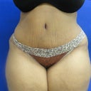 6 week post op