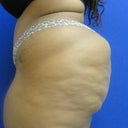 6 week post op