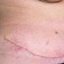 Scar line at 4 weeks post op.