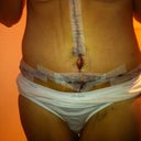 Day 5 dressing removed.  swollen and scary looking but I'm still happy.