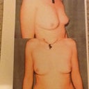 Before BA, very small A cups