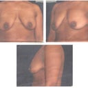 These are my before pics that were taken at Dr's office