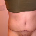 Post Op Day 18 (6-8-12)
(scar and BB is scabbing over ewwww! Going to start Mederma hopefully today)