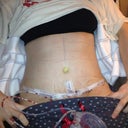 Post op day 2, I have a waist!!