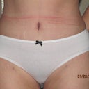 24 days post op