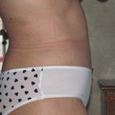 24 days post op