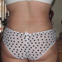 24 days post op