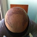 1day after