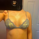 3 days post-op