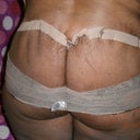 YEP I BIT THE BULLET AND WENT ALL THE WAY AROUND! WITH MY DR' ADVICE HOPEFULLY THE OUT COME WILL BE OUTSTANDING!!! 1-18-2013