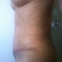 2 weeks 1 day...still very swollen!